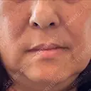 レーザートーニング（美白・肝斑） トラスト美容クリニック 銀座院 BEFORE サムネイル用