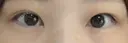 二重切開 / 目頭切開 / 眼瞼下垂（切開） EMMA CLINIC（エマクリニック） BEFORE サムネイル用