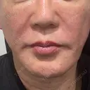 糸リフト / 脂肪吸引（顔） / ボトックス（あご） / ヒアルロン酸注入（あご） / ボトックス（エラ・小顔） / ヒアルロン酸注入（鼻翼基部） Tokyo Tensei Clinic 新宿院 BEFORE サムネイル用