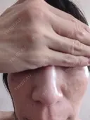 リジュラン ワンストップヘアクリニック 大阪院 BEFORE サムネイル用