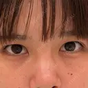 二重埋没 A CLINIC（エークリニック） 福岡院 BEFORE サムネイル用