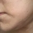 医療脱毛（ワキ） / ルメッカ ルラ美容クリニック 広島院 BEFORE サムネイル用