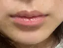 ヒアルロン酸注入（唇） 目白ホワイトクリニック BEFORE サムネイル用