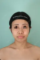 隆鼻術 / 鼻尖形成（切開） / 鼻中隔延長（切開） / その他（鼻） / 軟骨移植 / 鼻翼基部形成（貴族手術） / 鼻柱下降・鼻唇角形成（猫手術） WOM CLINIC GINZA （ワム クリニック ギンザ） BEFORE サムネイル用