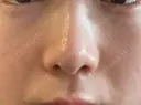 その他（鼻） リエンジャン整形外科 明洞店 BEFORE サムネイル用