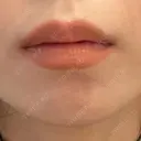 ヒアルロン酸注入（唇） 目白ホワイトクリニック BEFORE サムネイル用