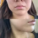 ハイフ（顔） ゆう美容クリニック BEFORE サムネイル用