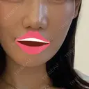 肌育注射（ジュベルックなど） / イオン導入 / ピーリング（ハリ・ツヤ） ゆう美容クリニック BEFORE サムネイル用