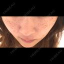 ピーリング（ニキビ・毛穴） / ルメッカ ルラ美容クリニック 横浜院 BEFORE サムネイル用