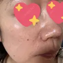 イオン導入 / レーザートーニング（美白・肝斑） Kinshicho Beauty Clinic （錦糸町ビューティークリニック） BEFORE サムネイル用