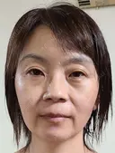 クマ治療 湘南美容クリニック 千葉センシティ院 BEFORE サムネイル用