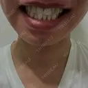 ホワイトニング ビジューデンタルサロン BEFORE サムネイル用
