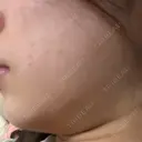 RF（高周波）たるみ治療 Wing clinic 豊中駅前院 BEFORE サムネイル用