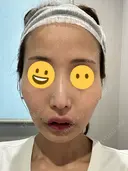 水光注射（ハリ・美肌） ちぐさ内科クリニック 覚王山 BEFORE サムネイル用