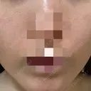 ポテンツァ ルラ美容クリニック 岡山院 BEFORE サムネイル用