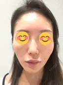 ピコレーザートーニング（美白・肝斑） シェリークリニック 渋谷院 BEFORE サムネイル用