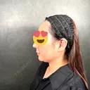 糸リフト / 脂肪吸引注射（顔） 新宿美容外科ネビュラクリニック BEFORE サムネイル用