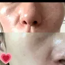 医療脱毛（顔） 新宿Ladies&Gentlemen美容クリニック BEFORE サムネイル用