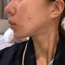 セットバック リッツ美容外科 東京院 BEFORE サムネイル用