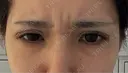 ボトックス（あご） / ボトックス（エラ・小顔） / ボトックス（口角） / ボトックス（眉間） Belle Via Skin Clinic BEFORE サムネイル用