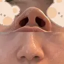 鼻尖形成（切開） / 小鼻縮小（切開） / 軟骨移植 ASTRA BEAUTY CLINIC BEFORE サムネイル用