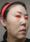 白玉点滴・注射 城本クリニック 大阪院 BEFORE サムネイル用