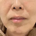ハイフ（顔） ARTE BEAUTY CLINIC BEFORE サムネイル用
