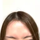 ボトックス（額） 大美会クリニック 京都烏丸院 BEFORE サムネイル用