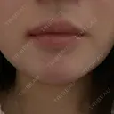 ボトックス（口角） / ボトックス（人中） DMTC CLINIC 日本橋院 BEFORE サムネイル用