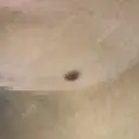 ほくろ・いぼ切除（肌） 大山皮膚科 BEFORE サムネイル用