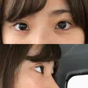 ヒアルロン酸注入（涙袋） 湘南美容クリニック 岐阜院 BEFORE サムネイル用