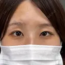 目頭切開 / その他（目元） ネビュラクリニック 京都院 BEFORE サムネイル用