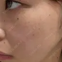 ルメッカ ルラ美容クリニック 大宮院 / ルラスキンクリニック 大宮院 BEFORE サムネイル用