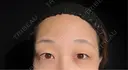 二重埋没 / 上まぶたの脂肪取り 9BeautyClinic BEFORE サムネイル用