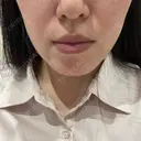 光治療（フォトフェイシャルなど） / ピーリング（ハリ・ツヤ） トラスト美容クリニック 銀座院 BEFORE サムネイル用