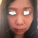 下まぶたたるみ取り アネシス美容クリニック BEFORE サムネイル用