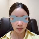 ボトックス（眉間） / ボトックス（額） / ヒアルロン酸注入（鼻翼基部） FIG CLINIC BEFORE サムネイル用