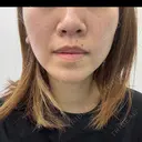 ベビーコラーゲン / RF（高周波）たるみ治療 TUNE CLINIC【チューンクリニック】 BEFORE サムネイル用