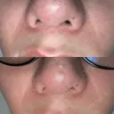 鼻翼基部形成（貴族手術） HAAB BEAUTY CLINIC 名古屋院 BEFORE サムネイル用