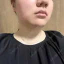 脂肪溶解注射（顔） / ニキビ治療 SUI CLINIC BEFORE サムネイル用