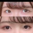 ヒアルロン酸注入（涙袋） / ボトックス（エラ・小顔） / ヒアルロン酸注入（唇） DMTC美容皮膚科 大宮院 BEFORE サムネイル用