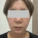 RF（高周波）たるみ治療 Wi Clinic （ウィ クリニック）心斎橋院 BEFORE サムネイル用