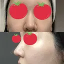 ヒアルロン酸注入（鼻） A CLINIC（エークリニック） 横浜院 BEFORE サムネイル用