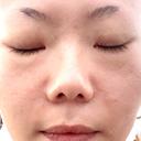 その他（輪郭） / ボトックス（眉間） TCB東京中央美容外科 福岡天神院 BEFORE サムネイル用