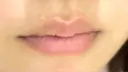 ヒアルロン酸注入（唇） プライベートスキンクリニック 梅田本院 BEFORE サムネイル用