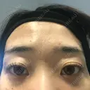 その他（目元） コムロクリニック 東京銀座院 BEFORE サムネイル用