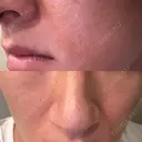 ルメッカ / ミラノリピール ON-CLINIC Beauty BEFORE サムネイル用