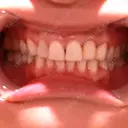 矯正（ワイヤー） / セラミック 東京美容外科 赤坂院 BEFORE サムネイル用