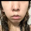 ルメッカ ルラ美容クリニック 岡山院 BEFORE サムネイル用