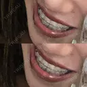 矯正（ワイヤー） Shiny Teeth Clinic 【シャイニー ティース クリニック】 BEFORE サムネイル用
